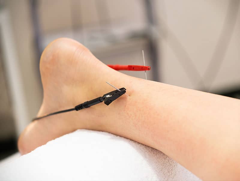 Dry Needling