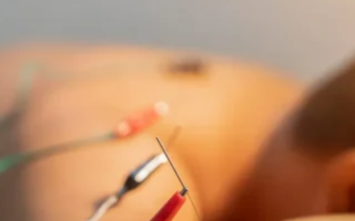 Dry needling